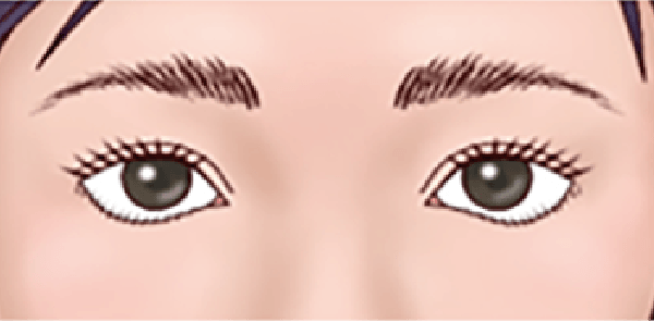 下眼瞼拡大修正術 前の目元イラスト